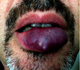 Image angiome lèvre inférieure